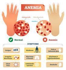 What is anemia and what does it do?-example-1